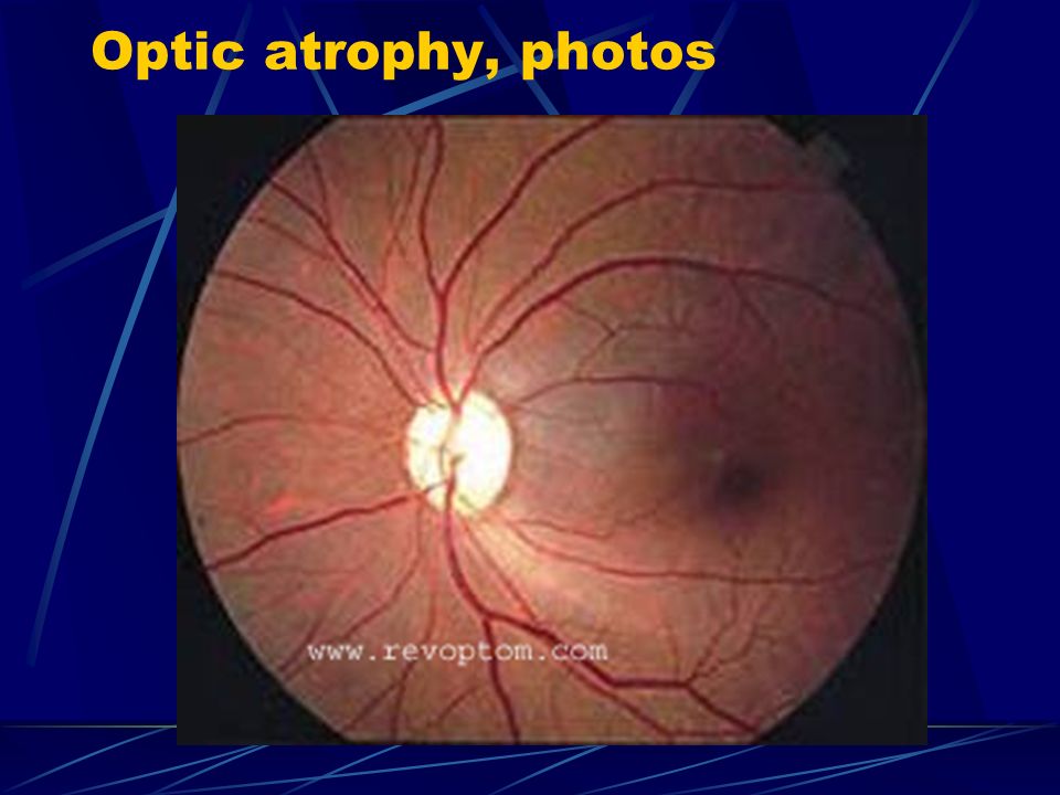 Optic atrophy, photos