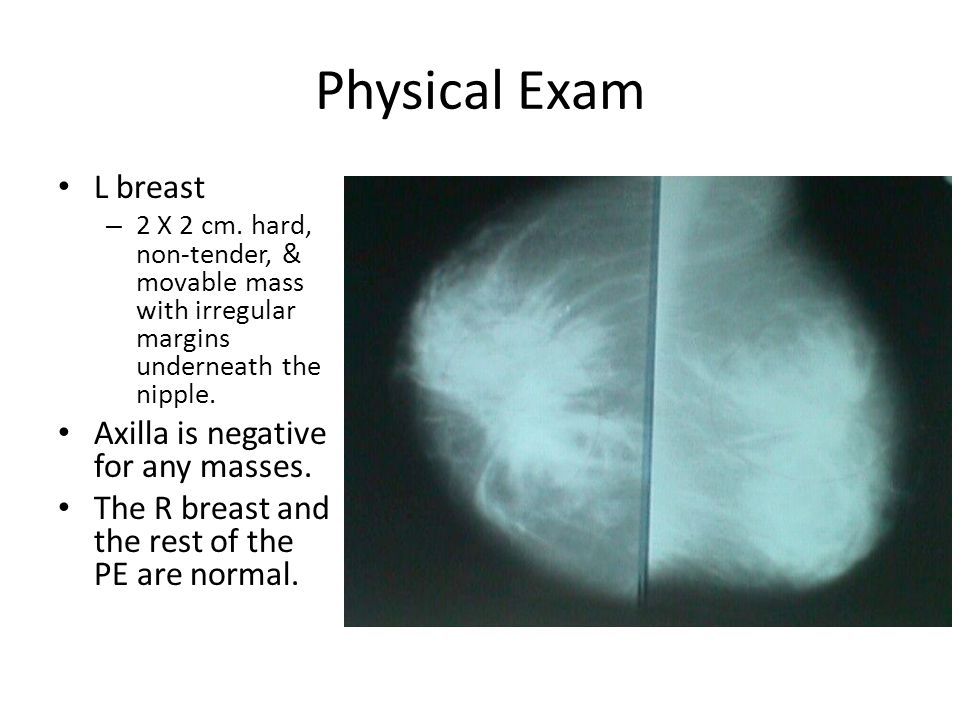 movable breast mass Movable breast mass