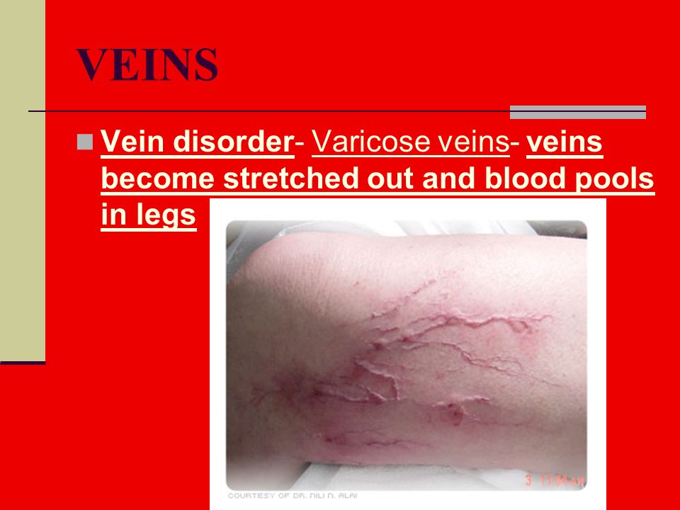VEINS Vein disorder- Varicose veins- veins become stretched out and blood pools in legs