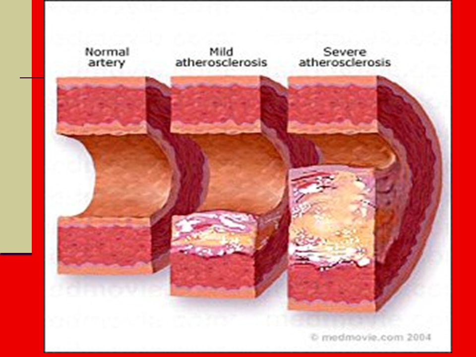 Disorders of Circulatory System Atherosclerosis- (hardening of the arteries) excess cholesterol and fat deposits on inner walls of arteries restricting blood flow and increasing blood pressure Treatment- Cholesterol medication (Lipitor) and diet restriction of fat and cholesterol