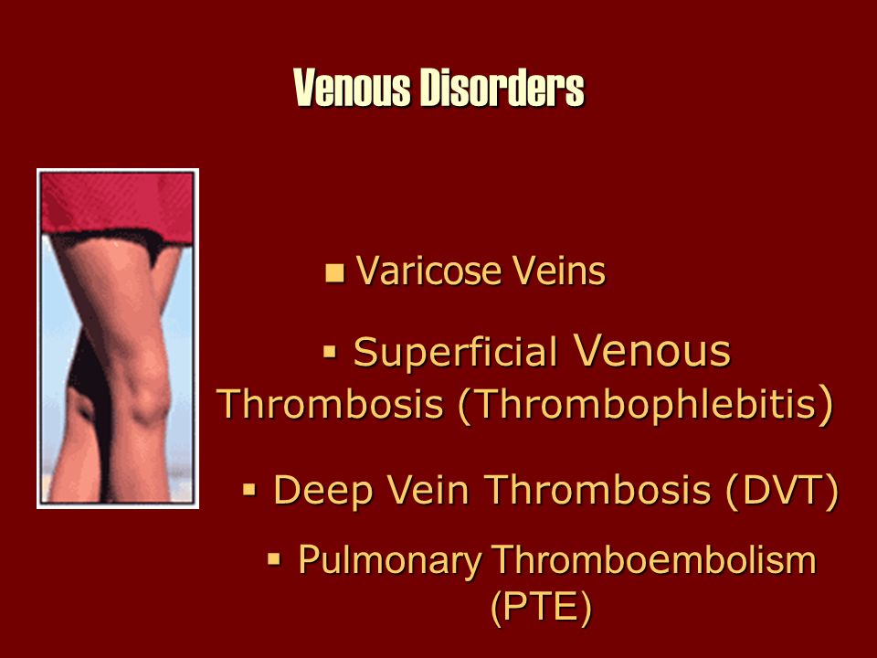 thrombo varicose)