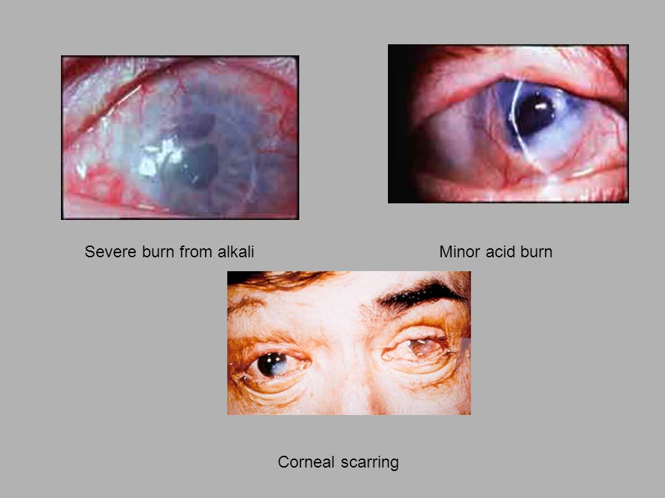 Severe burn from alkaliMinor acid burn Corneal scarring
