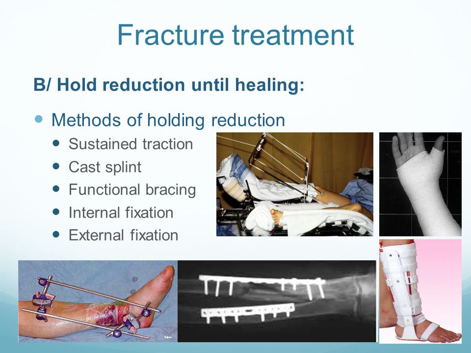 Fracture treatment A/ Reduce the fracture: Closed reduction Open reduction  Articular fractures: Need anatomical reduction. - ppt download