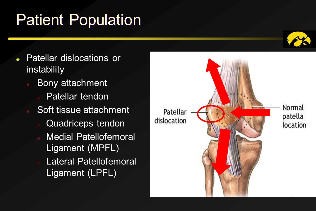 Patient Population Patellar dislocations or instability Bony attachment Pat...