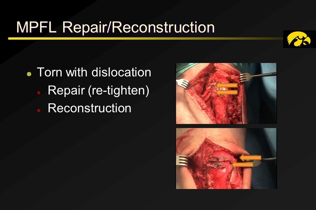 MPFL Repair/Reconstruction ] Torn with dislocation ] Repair (re-tighten) ] Reconstruction