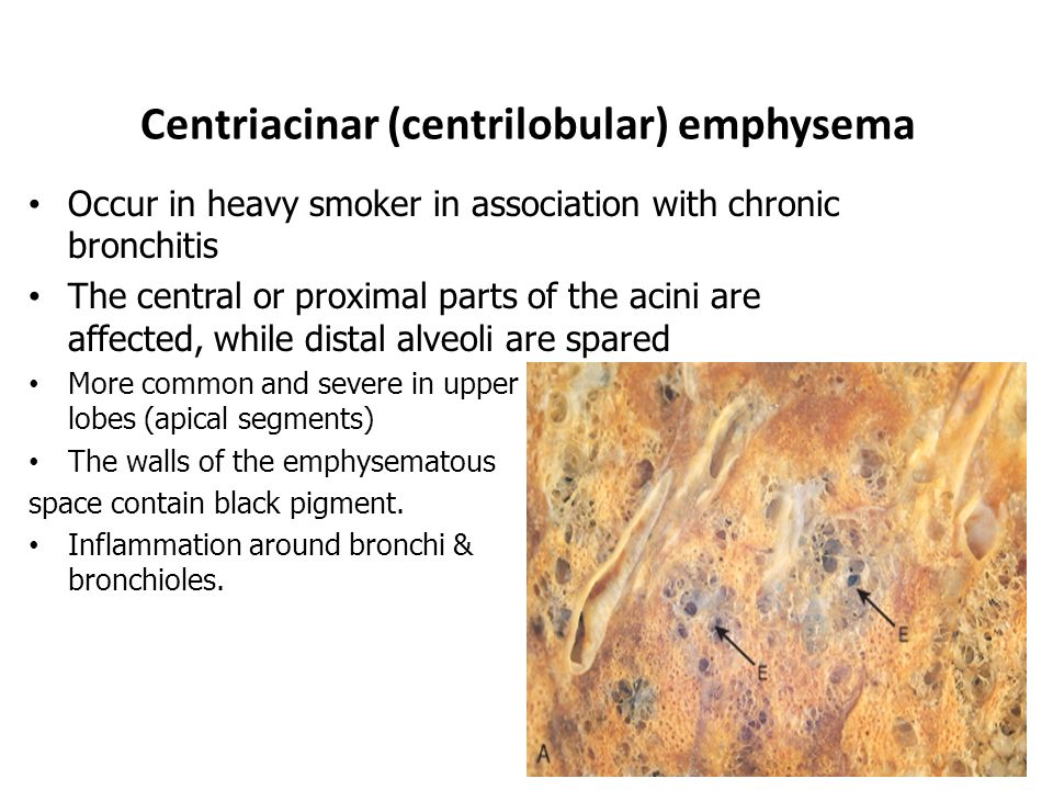 Centriacinar (centrilobular) emphysema Occur in heavy smoker in association with chronic bronchitis The central or proximal parts of the acini are affected, while distal alveoli are spared More common and severe in upper lobes (apical segments) The walls of the emphysematous space contain black pigment.