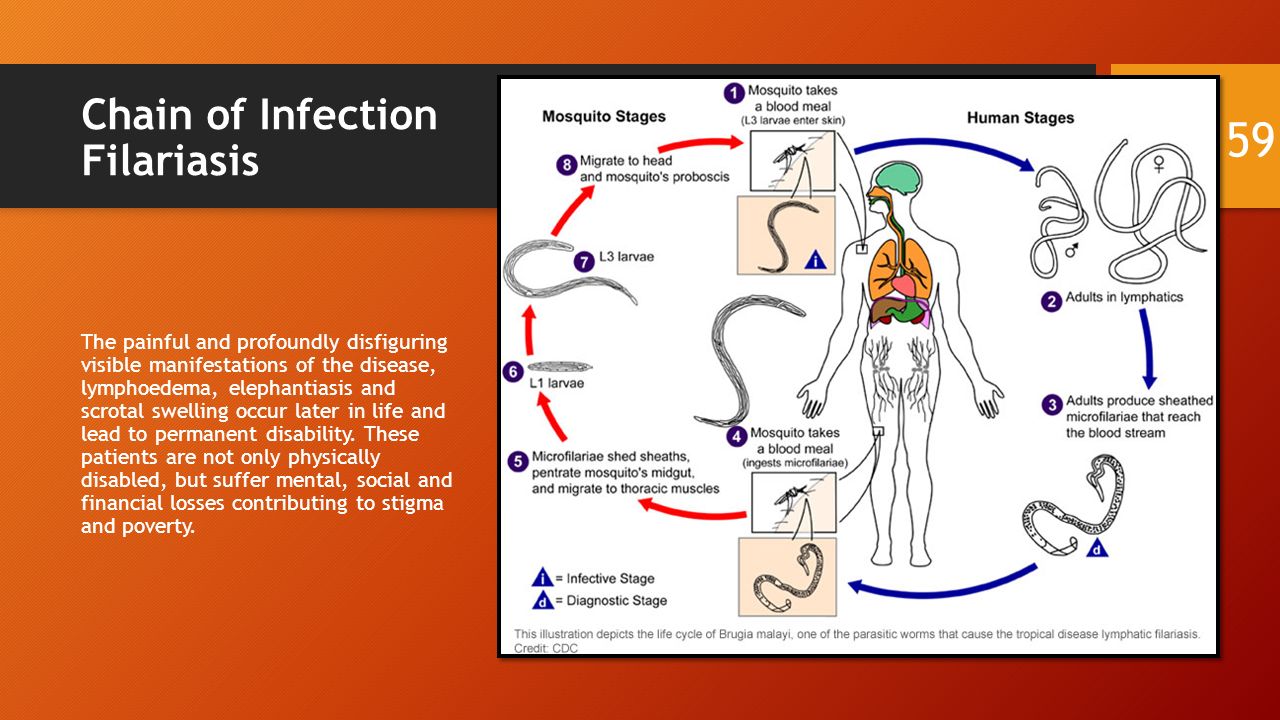 Chain of Infection Filariasis The painful and profoundly disfiguring visible manifestations of the disease, lymphoedema, elephantiasis and scrotal swelling occur later in life and lead to permanent disability.