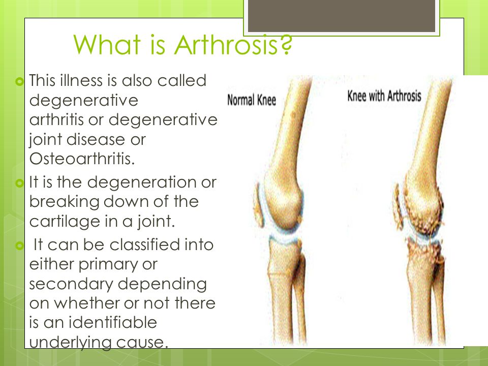 What's the difference between arthritis and arthrosis?