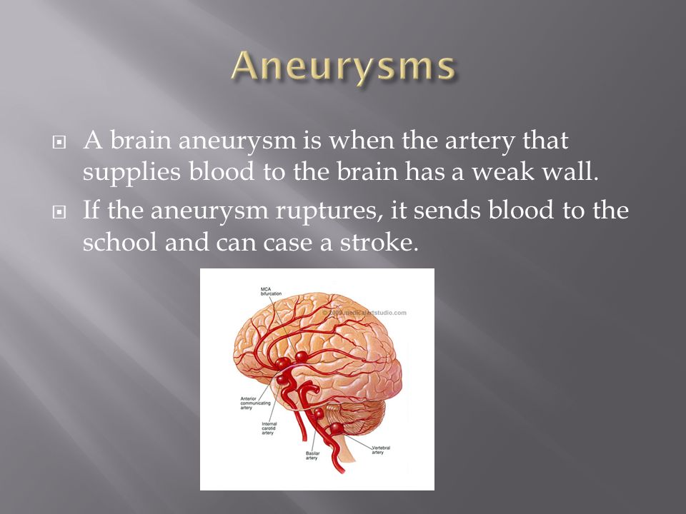  A brain aneurysm is when the artery that supplies blood to the brain has a weak wall.