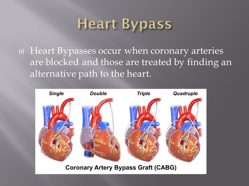  Heart Bypasses occur when coronary arteries are blocked and those are treated by finding an alternative path to the heart.