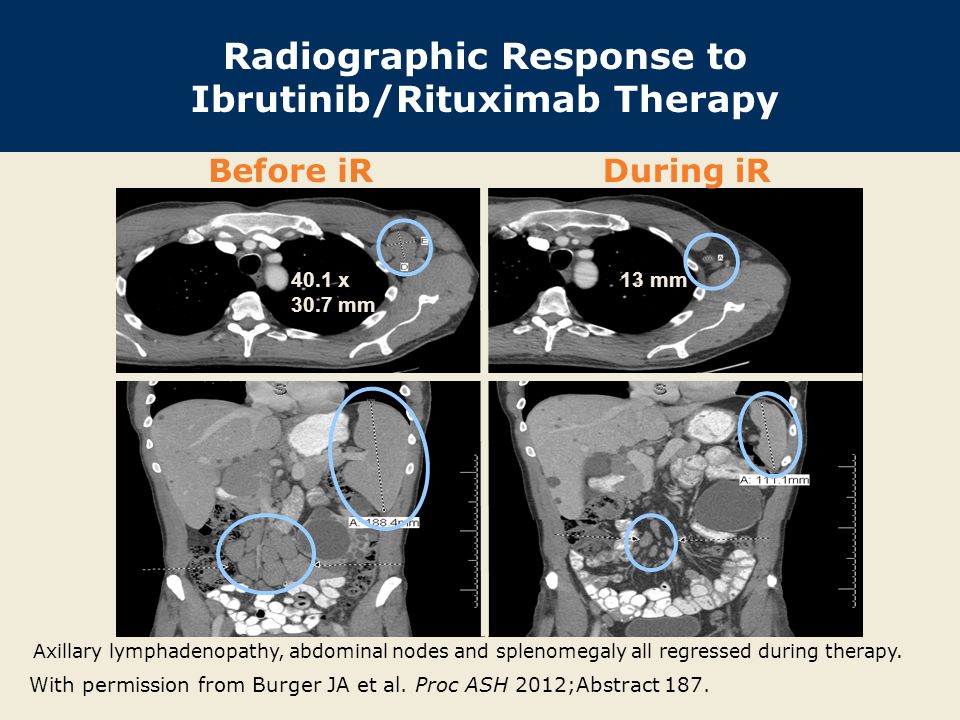 Radiographic Response to Ibrutinib/Rituximab Therapy With permission from Burger JA et al.