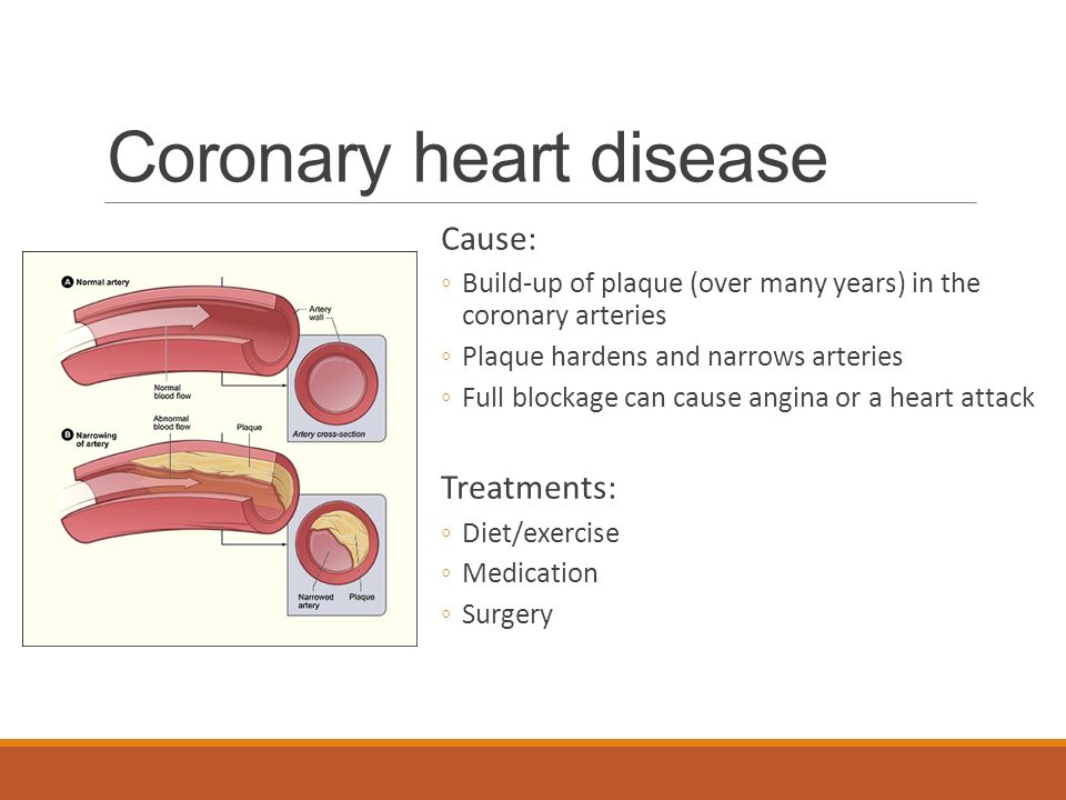 Coronary heart disease Cause: ◦Build-up of plaque (over many years) in the coronary arteries ◦Plaque hardens and narrows arteries ◦Full blockage can cause angina or a heart attack Treatments: ◦Diet/exercise ◦Medication ◦Surgery