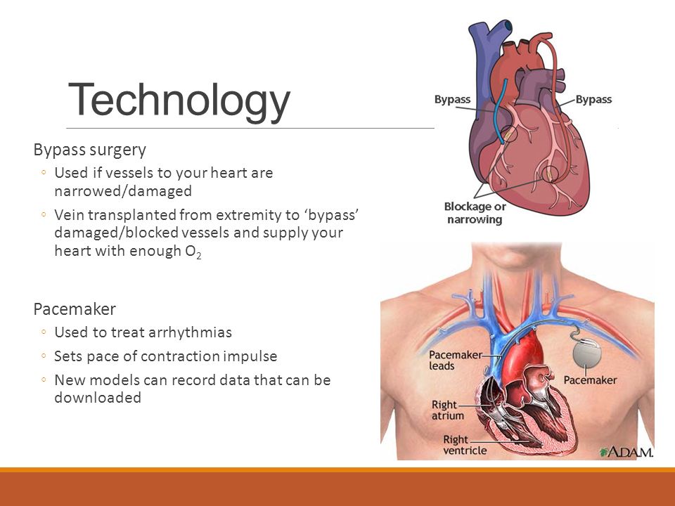 Technology Bypass surgery ◦Used if vessels to your heart are narrowed/damaged ◦Vein transplanted from extremity to ‘bypass’ damaged/blocked vessels and supply your heart with enough O 2 Pacemaker ◦Used to treat arrhythmias ◦Sets pace of contraction impulse ◦New models can record data that can be downloaded