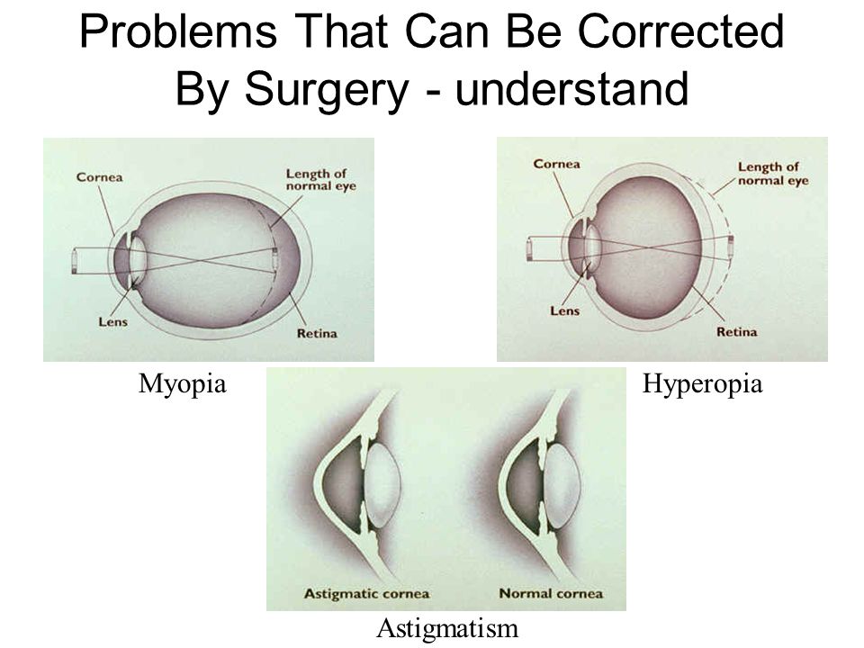 Laser Eye Surgery And other surgical vision correction. - ppt download