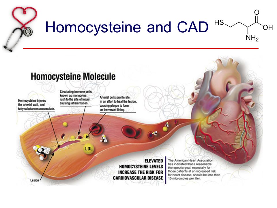 Homocysteine and CAD