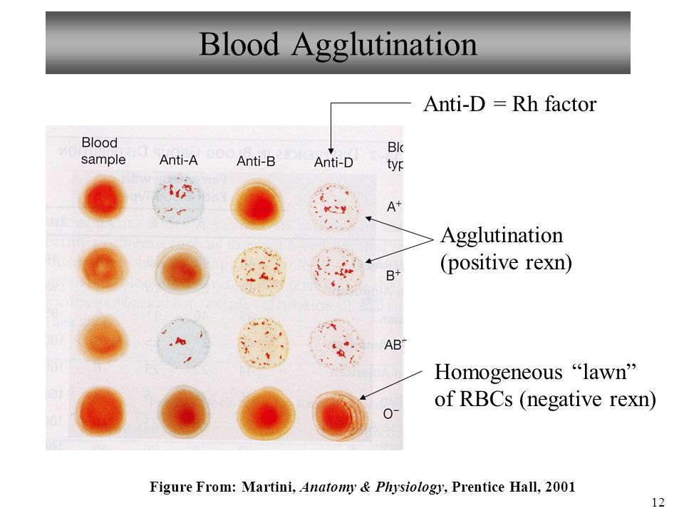 12 Blood Agglutination Anti-D = Rh factor Agglutination (positive rexn) Homogeneous lawn of RBCs (negative rexn) Figure From: Martini, Anatomy & Physiology, Prentice Hall,