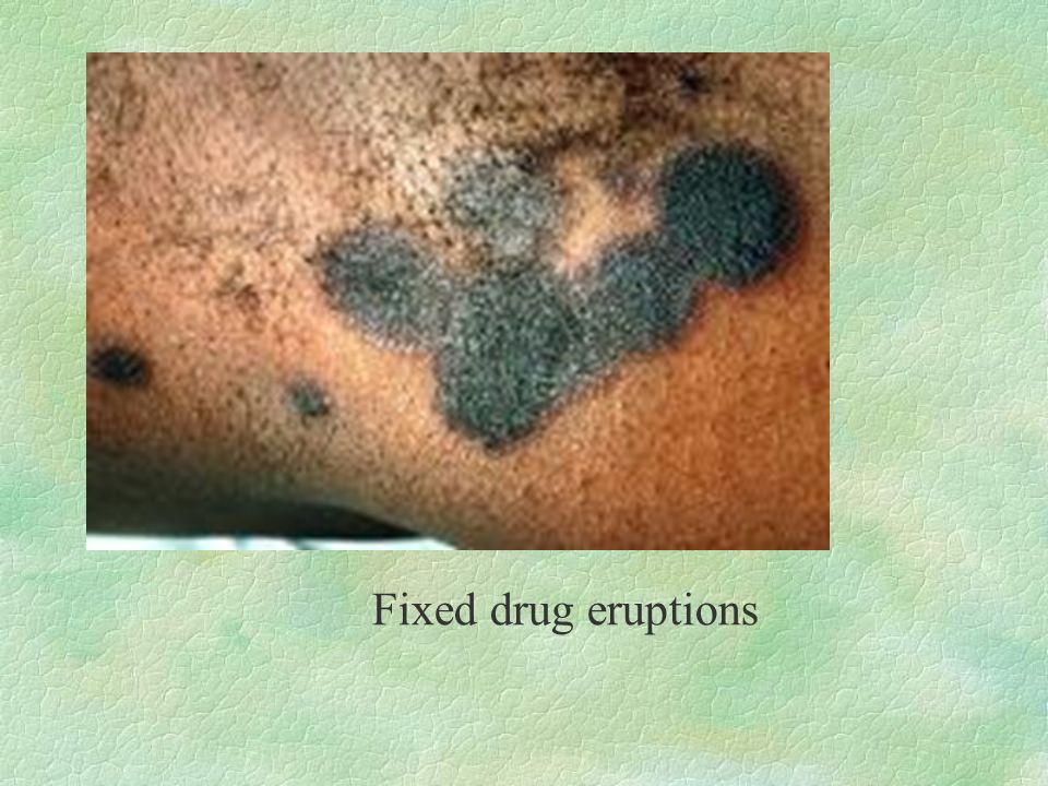 Fixed drug eruptions