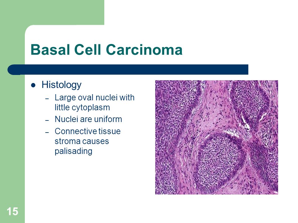 Cancer Of Skin Of Face And Lips Histological Structure Clinical