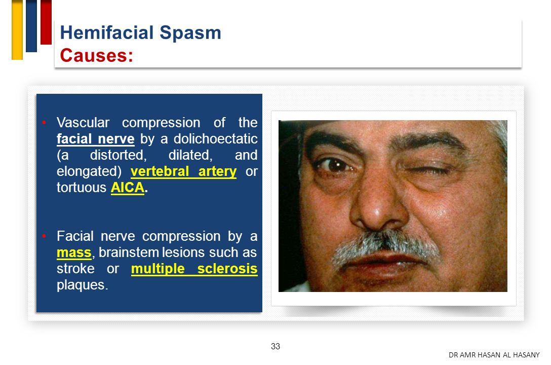 Multiple sclerosis facial twitch