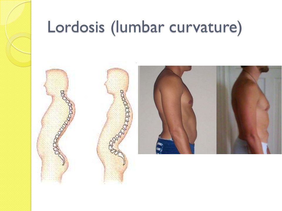 Lordosis ( lumbar curvature.