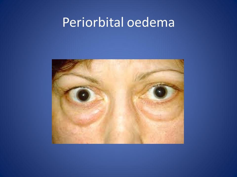 Periorbital oedema
