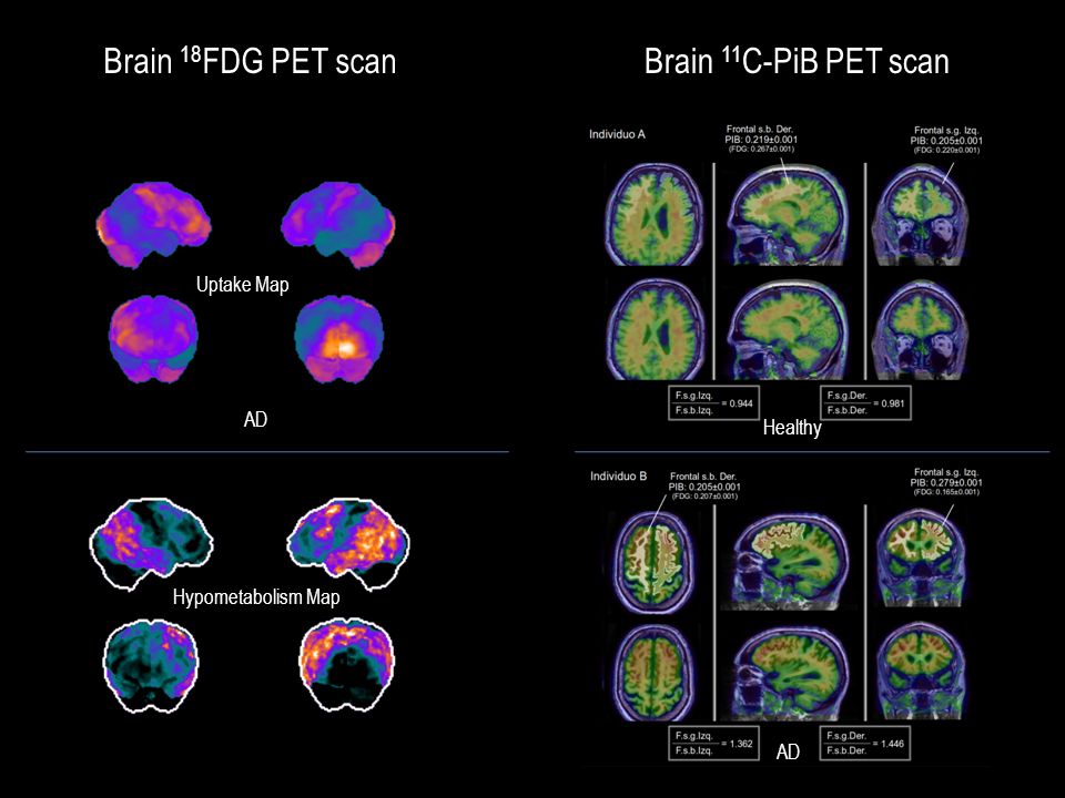 Brain 18 FDG PET scan Uptake Map Hypometabolism Map Brain 11 C-PiB PET scan Healthy AD