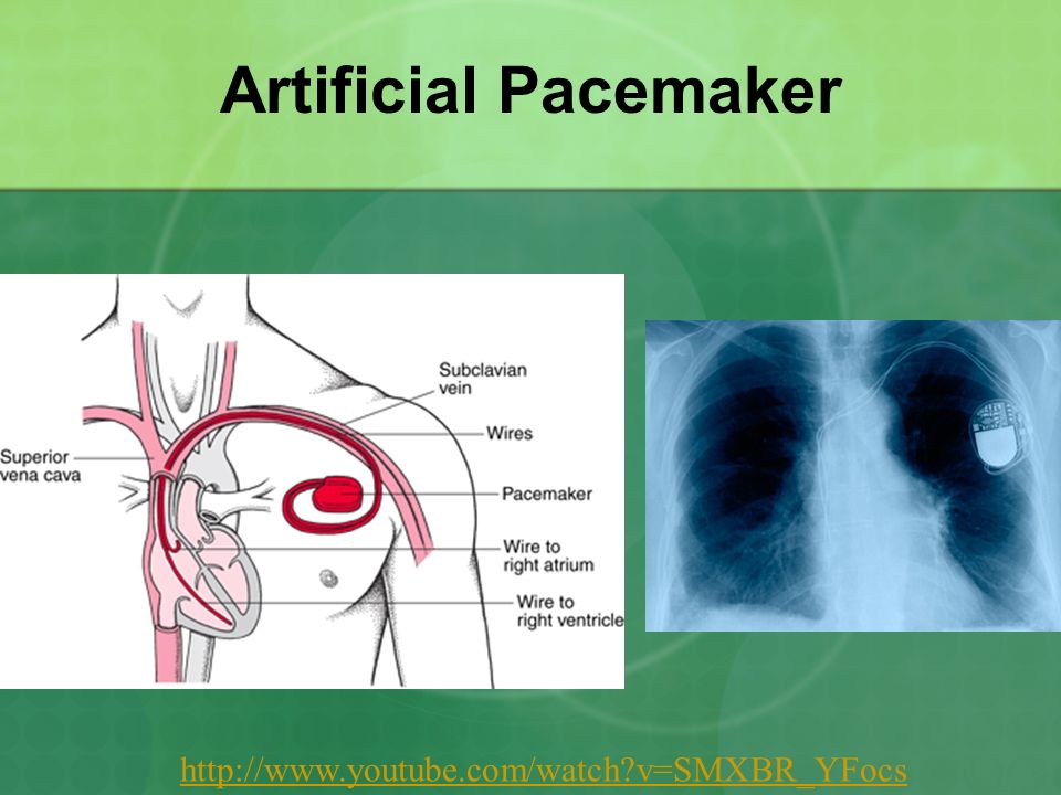 Artificial Pacemaker   v=SMXBR_YFocs
