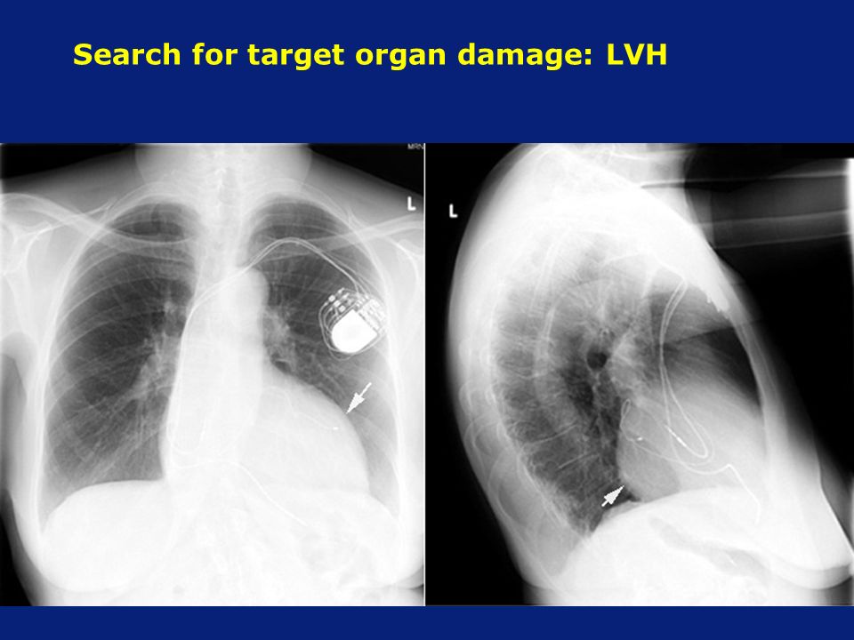 Search for target organ damage: LVH