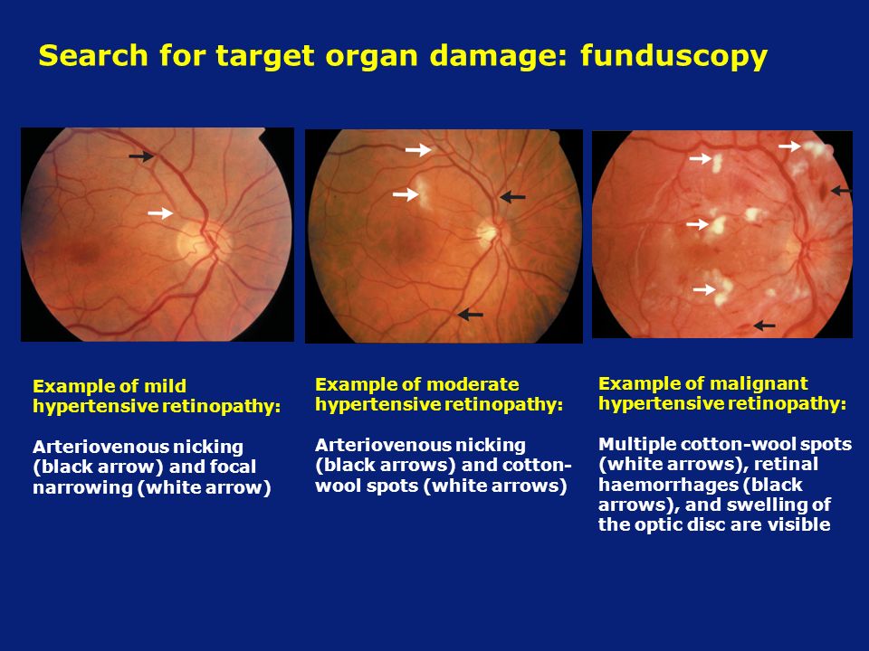 Search for target organ damage: funduscopy Example of moderate hypertensive retinopathy: Arteriovenous nicking (black arrows) and cotton- wool spots (white arrows) Example of mild hypertensive retinopathy: Arteriovenous nicking (black arrow) and focal narrowing (white arrow) Example of malignant hypertensive retinopathy: Multiple cotton-wool spots (white arrows), retinal haemorrhages (black arrows), and swelling of the optic disc are visible