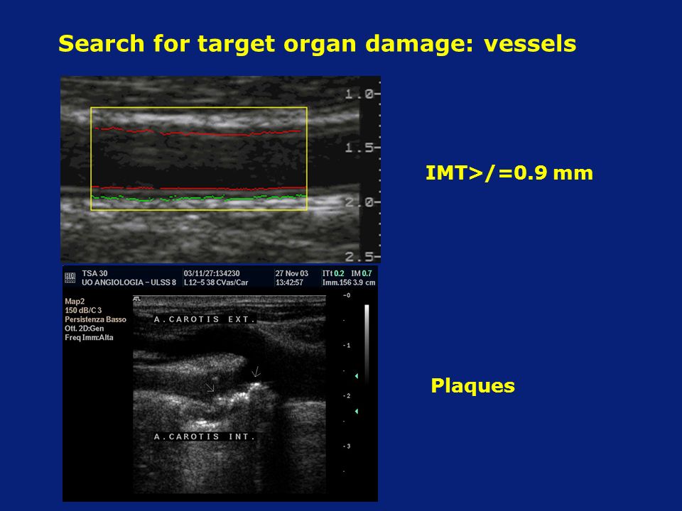 Search for target organ damage: vessels IMT>/=0.9 mm Plaques