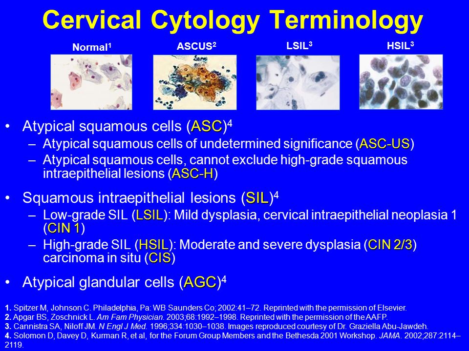 Cervical Cytology Terminology ASCAtypical squamous cells (ASC) 4 ASC-US –Atypical squamous cells of undetermined significance (ASC-US) ASC-H –Atypical squamous cells, cannot exclude high-grade squamous intraepithelial lesions (ASC-H) SILSquamous intraepithelial lesions (SIL) 4 LSIL CIN 1 –Low-grade SIL (LSIL): Mild dysplasia, cervical intraepithelial neoplasia 1 (CIN 1) HSILCIN 2/3 CIS –High-grade SIL (HSIL): Moderate and severe dysplasia (CIN 2/3) carcinoma in situ (CIS) AGCAtypical glandular cells (AGC) 4 1.