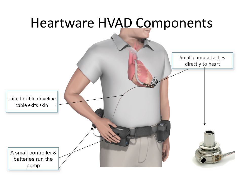community preparation for caring for mechanical circulatory device
