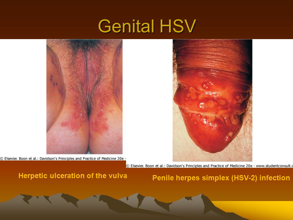 Genital HSV Herpetic ulceration of the vulva Penile herpes simplex (HSV-2) ...