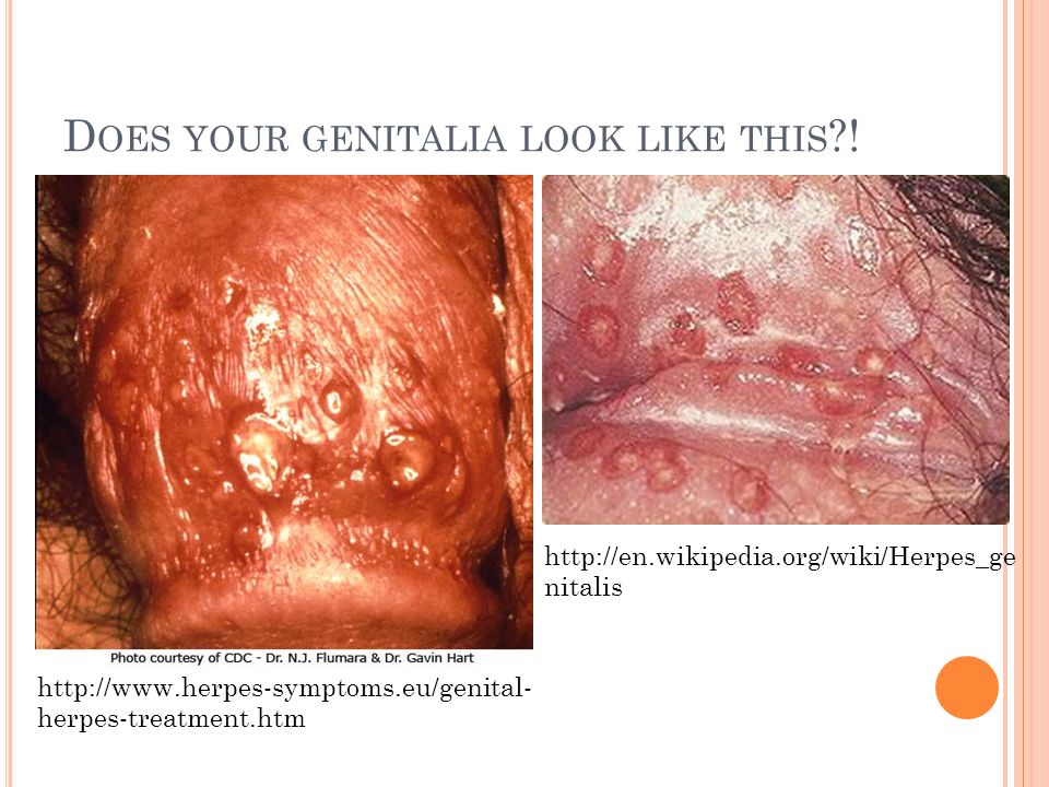 H ERPES S IMPLEX 2 Ryan Hoover Brad Hess. D OES YOUR GENITALIA LOOK LIKE  THIS ?! nitalis - ppt download