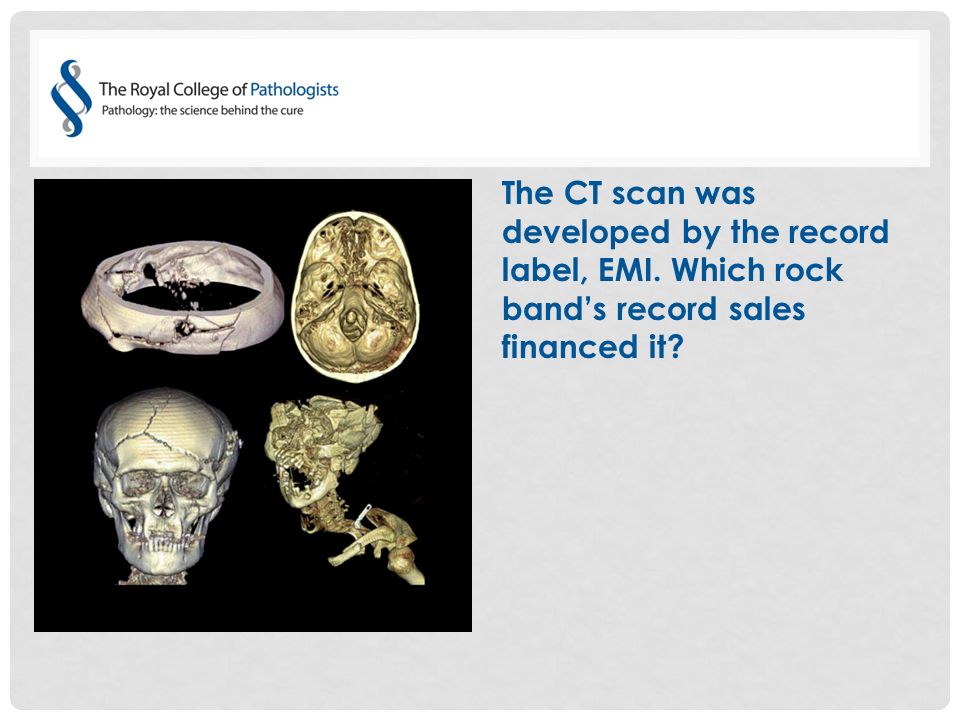 The CT scan was developed by the record label, EMI. Which rock band’s record sales financed it