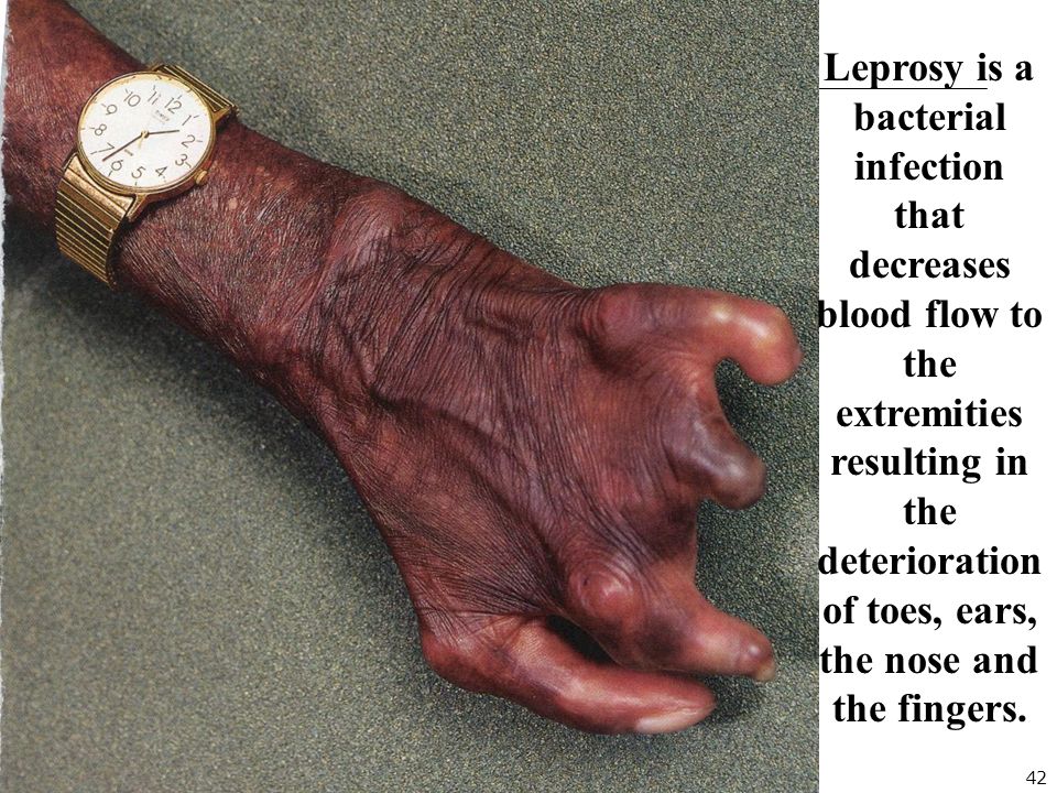 42 Leprosy is a bacterial infection that decreases blood flow to the extremities resulting in the deterioration of toes, ears, the nose and the fingers.