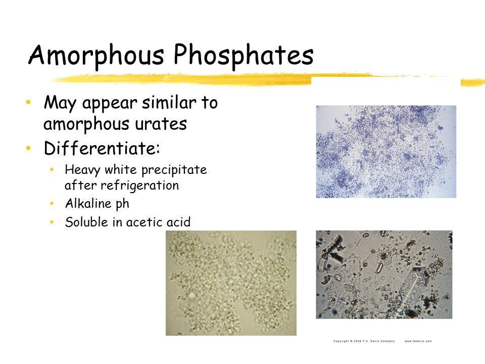 amorphous urates in urine