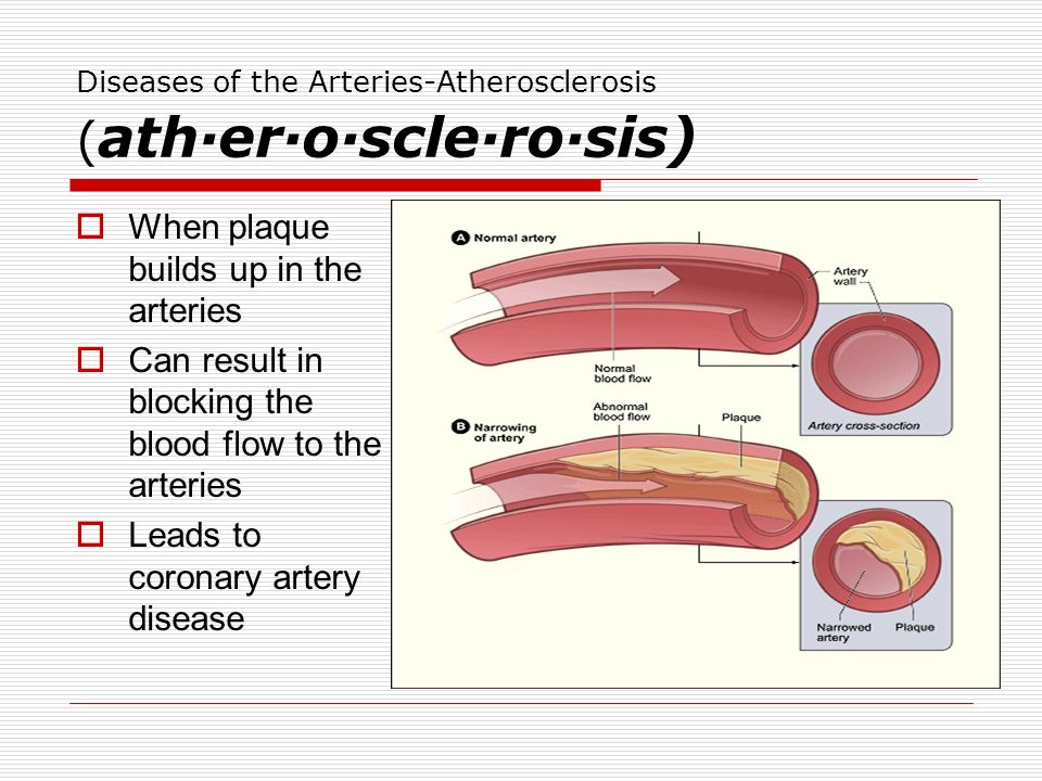 Diseases of the Arteries-Atherosclerosis ( ath·er·o·scle·ro·sis)  When plaque builds up in the arteries  Can result in blocking the blood flow to the arteries  Leads to coronary artery disease