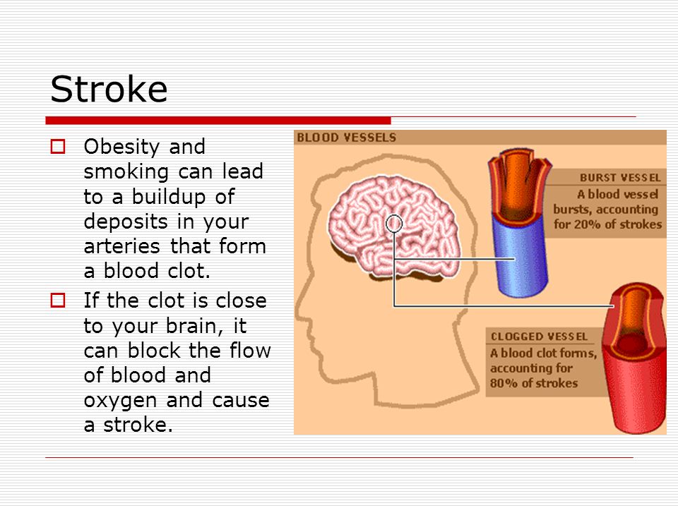 Stroke  Obesity and smoking can lead to a buildup of deposits in your arteries that form a blood clot.