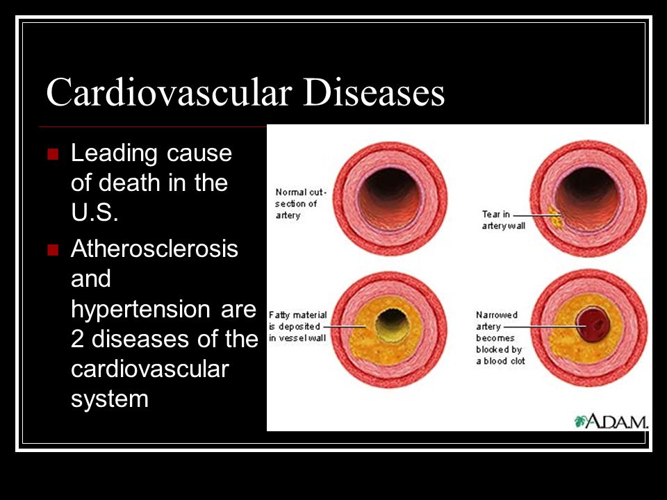 Cardiovascular Diseases Leading cause of death in the U.S.