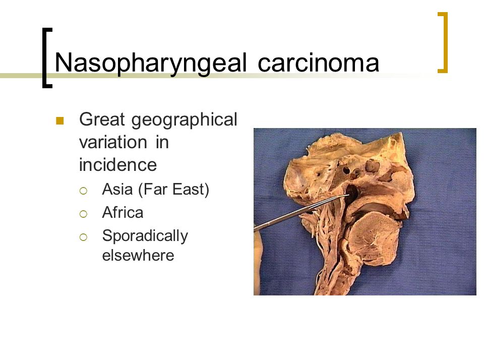 Nasopharyngeal carcinoma Great geographical variation in incidence  Asia (Far East)  Africa  Sporadically elsewhere