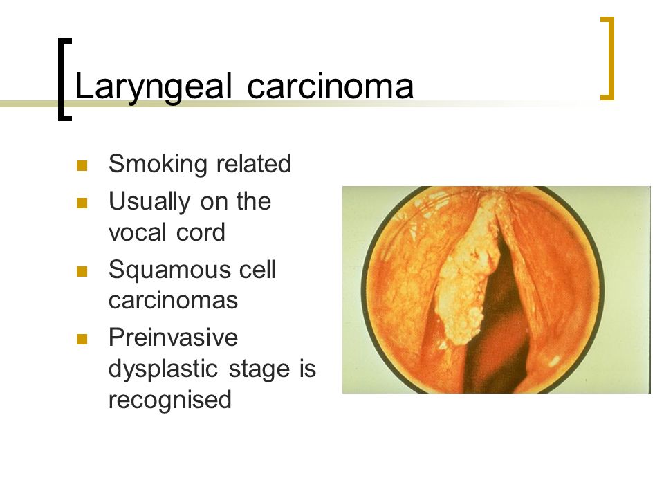 Laryngeal carcinoma Smoking related Usually on the vocal cord Squamous cell carcinomas Preinvasive dysplastic stage is recognised