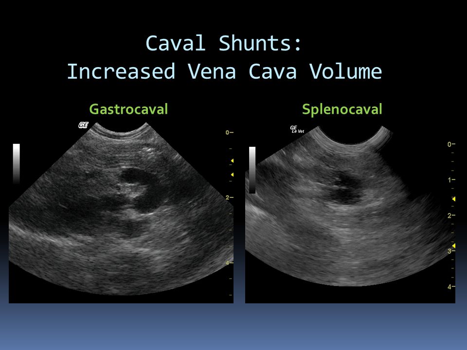 Caval Shunts: Increased Vena Cava Volume GastrocavalSplenocaval