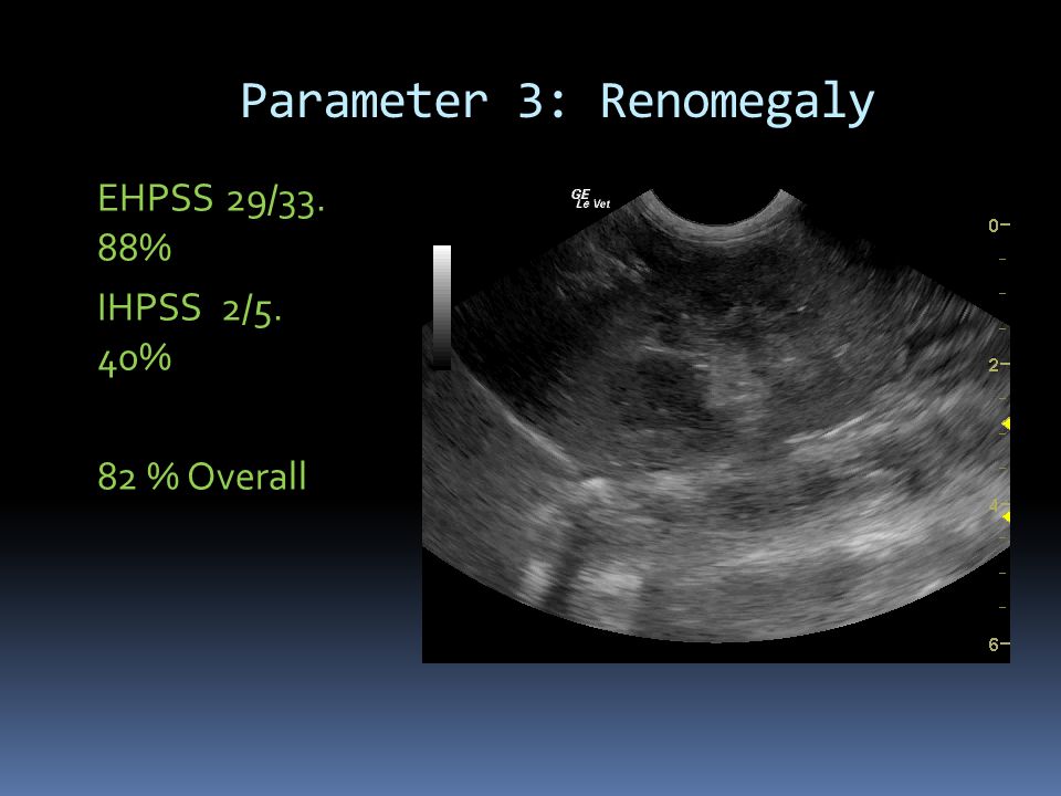 Parameter 3: Renomegaly EHPSS 29/33. 88% IHPSS 2/5. 40% 82 % Overall