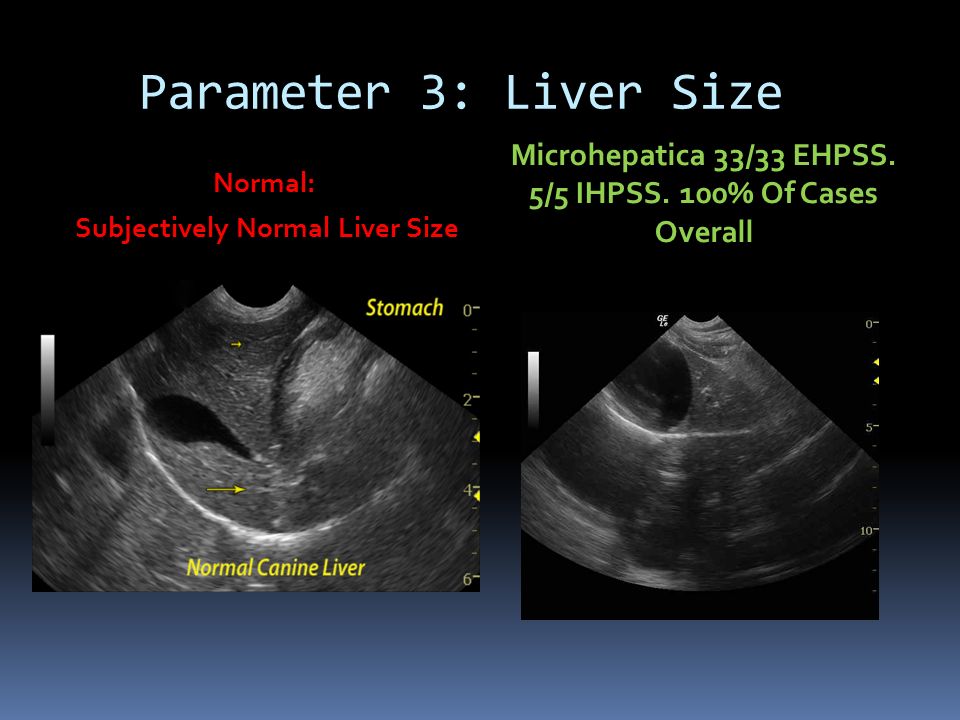 Parameter 3: Liver Size Normal: Subjectively Normal Liver Size Microhepatica 33/33 EHPSS.