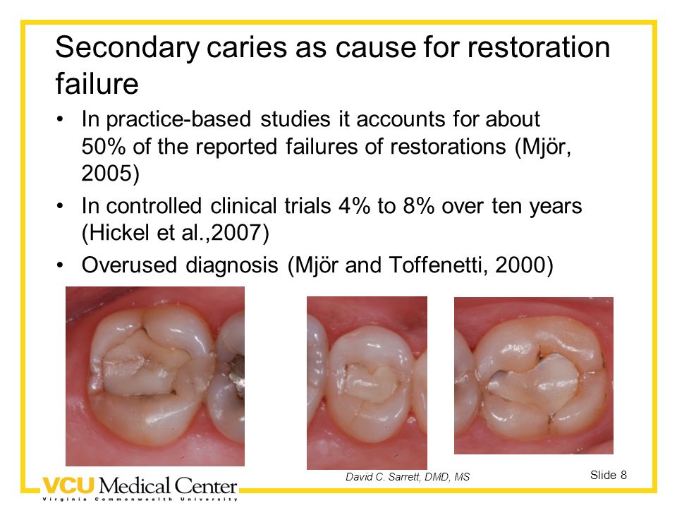 secondary caries
