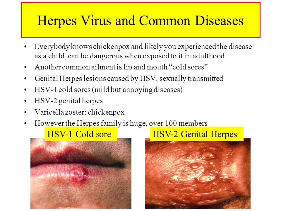 Herpes Virus and Common Diseases Everybody knows chickenpox and likely you ...