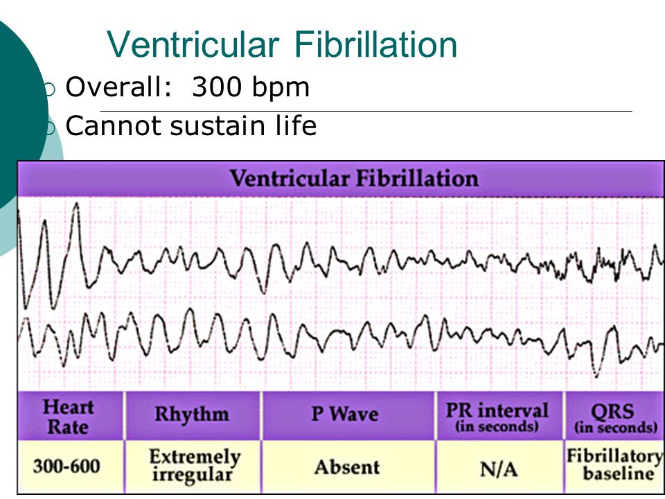 Ventricular Fibrillation ? 