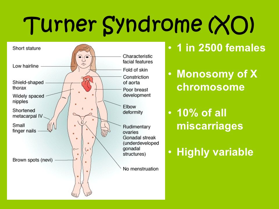 Turner Syndrome (XO) 1 in 2500 females Monosomy of X chromosome 10% of all ...