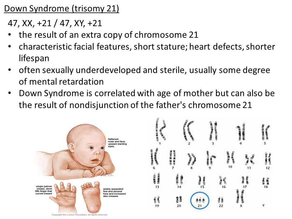 Down Syndrome (trisomy 21) 47, XX, +21 / 47, XY